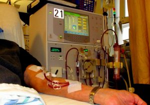 Arm of patient receiving dialysis.